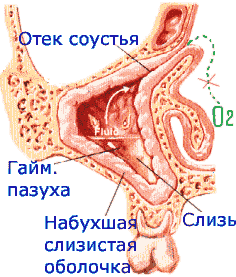 Синусит (гайморит) острый, симптомы - Клиника Здоровье г. Екатеринбург